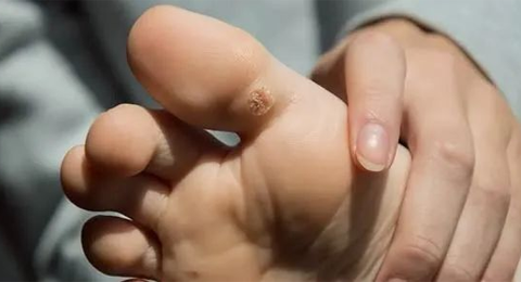 跖疣还是鸡眼怎么区分