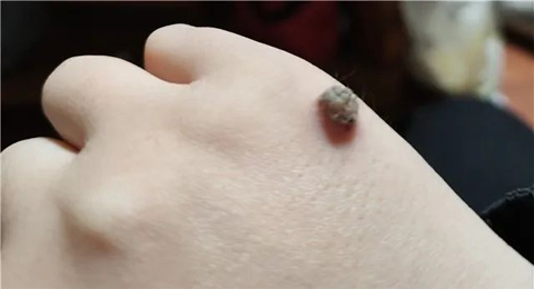 揭秘病毒疣：了解预防与治疗方法