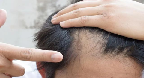 为什么会脱发?需要去医院就诊吗?脱发了应该怎么做?