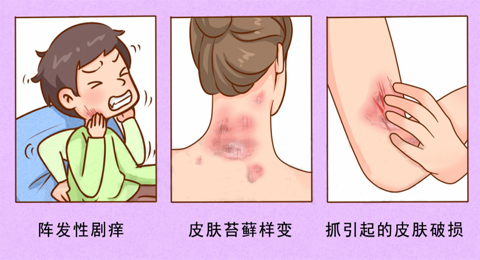 皮肤痒不停，神经性皮炎反复发作怎么办?