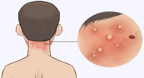 反复发生的皮肤问题-毛囊炎，千万不要忽视