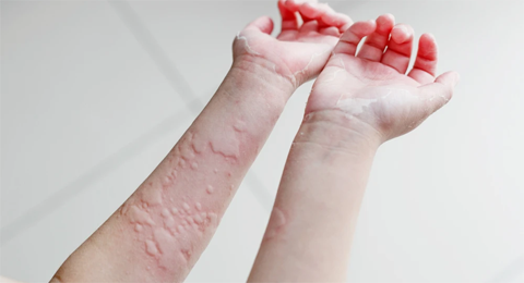 告别“风团”纠缠，解锁荨麻疹的防治密码！