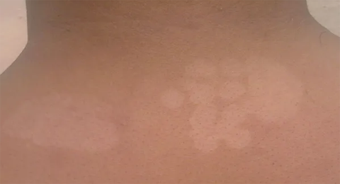 汗斑来袭,治疗汗斑的最佳方法