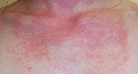 日光性皮炎你了解吗？如何应对？