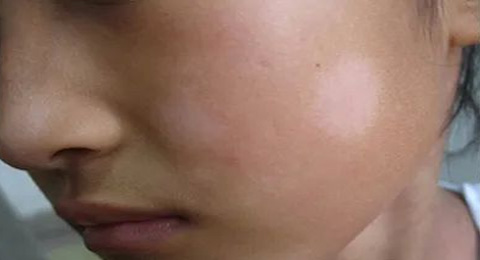 小孩脸上有一块白色斑块，是什么原因？
