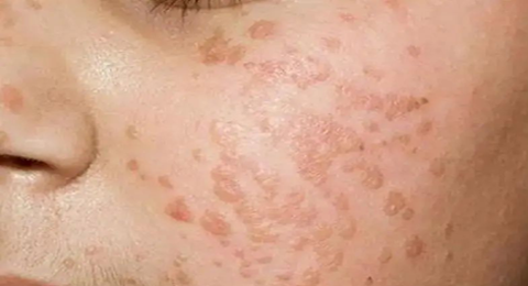 当心这种小疙瘩 可能越挤越多？