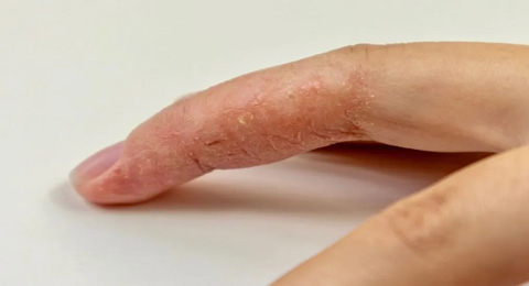 手指湿疹“反反复复”该怎么治疗？