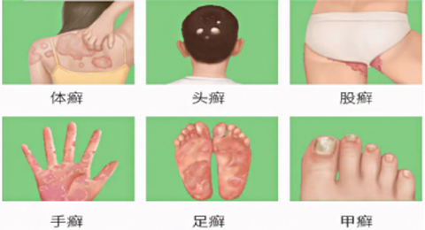 皮肤癣菌病为什么易在秋季高发？有哪些危害？