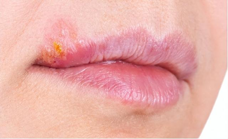 嘴角疱疹结痂不要抠，否则越来越严重