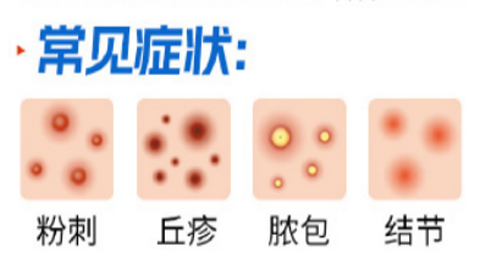 痤疮和毛囊炎怎么区分呢？发病原因和症状有什么不同？快来看看吧！