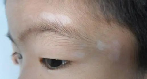 孩子患上白癜风，家长采取这些策略来积极应对！