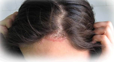 头部银屑病快好的6大征兆‼️快看你有没有‼
